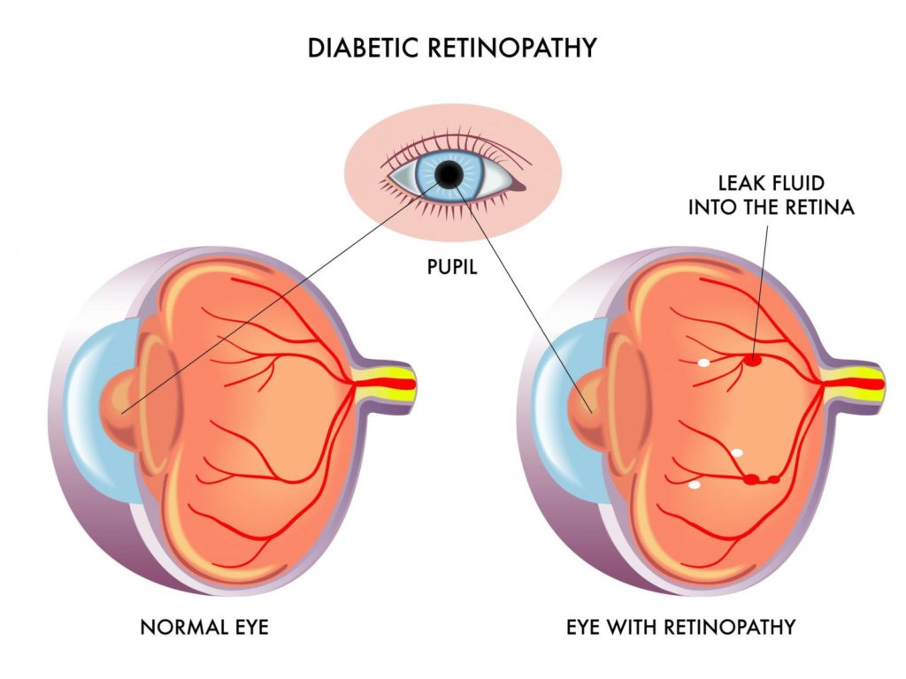 Diabetic Retinopathy: What You Need to Know to Protect Your Vision