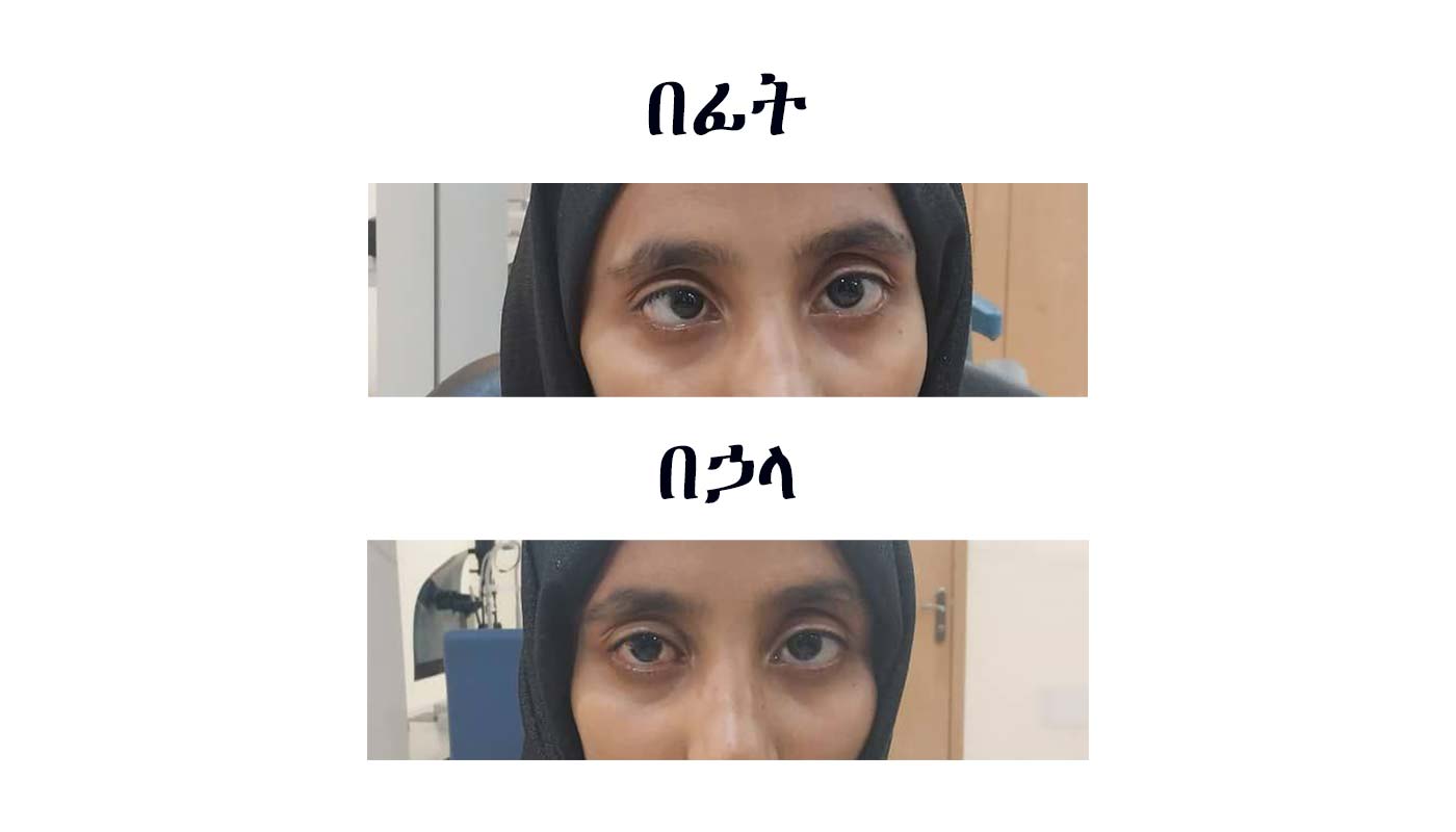 Amblyopia and Strabismus: What Every Parent Should Know